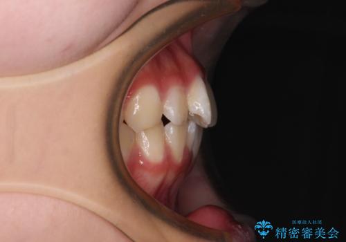 インビザラインは使える自信がない ワイヤー装置にて矯正治療の治療前