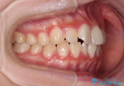 インビザラインは使える自信がない ワイヤー装置にて矯正治療の治療前