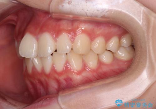 インビザラインは使える自信がない ワイヤー装置にて矯正治療の治療前