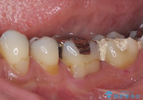 治療をしても違和感の続く奥歯　神経を極力残した虫歯治療の治療前