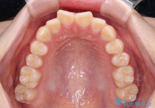 インビザラインは使える自信がない ワイヤー装置にて矯正治療の治療前