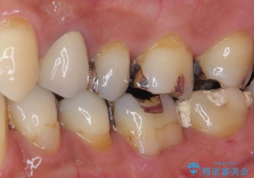 治療をしても違和感の続く奥歯 神経を極力残した虫歯治療の治療前