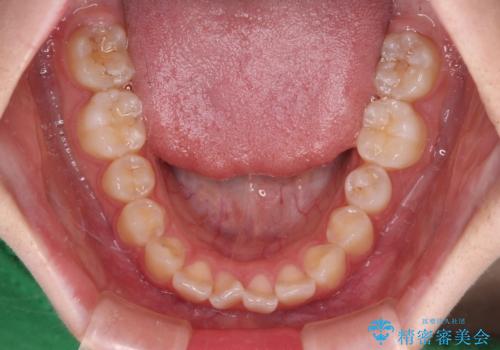 インビザラインは使える自信がない ワイヤー装置にて矯正治療の治療前