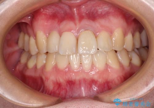 虫歯治療ついでに歯並びの後戻りを改善 インビザラインによる矯正治療の治療中