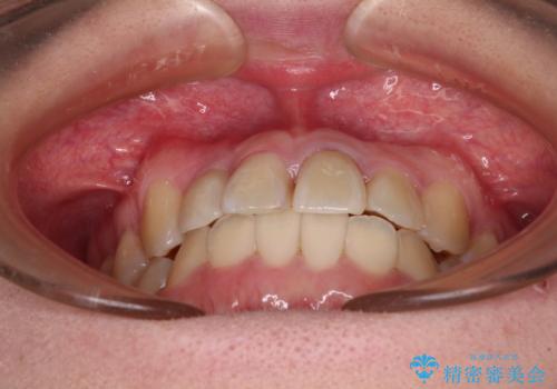 虫歯治療ついでに歯並びの後戻りを改善 インビザラインによる矯正治療の治療中