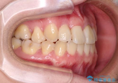 虫歯治療ついでに歯並びの後戻りを改善 インビザラインによる矯正治療の治療中