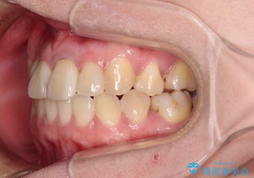 虫歯治療ついでに歯並びの後戻りを改善　インビザラインによる矯正治療の治療中