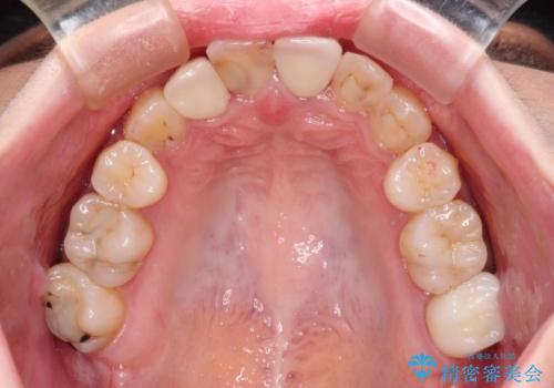 虫歯治療ついでに歯並びの後戻りを改善 インビザラインによる矯正治療の治療中