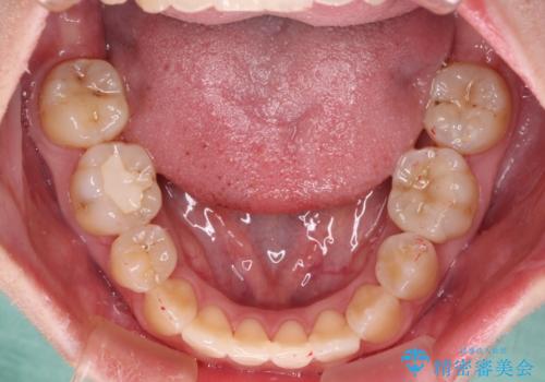 虫歯治療ついでに歯並びの後戻りを改善　インビザラインによる矯正治療の治療中