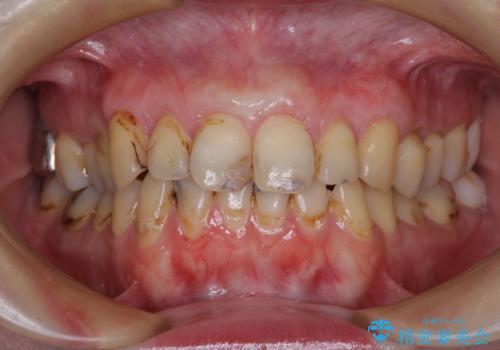 むし歯だらけの前歯をオールセラミッククラウンできれいにの治療中