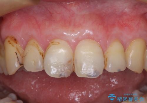 むし歯だらけの前歯をオールセラミッククラウンできれいにの治療中