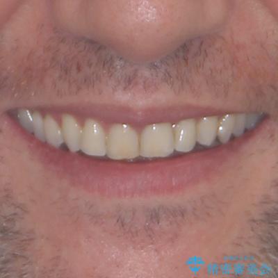 前歯でものを噛みきりたい 目立たない装置でのワイヤー矯正の治療前(顔貌)