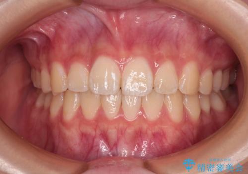 インビザラインは使える自信がない ワイヤー装置にて矯正治療の症例 治療後