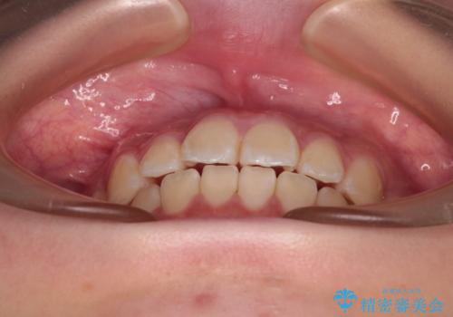 インビザラインは使える自信がない ワイヤー装置にて矯正治療の治療後