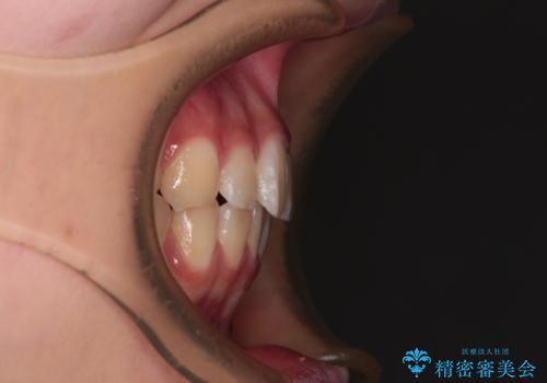 インビザラインは使える自信がない ワイヤー装置にて矯正治療の治療後