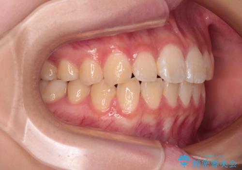 インビザラインは使える自信がない ワイヤー装置にて矯正治療の治療後