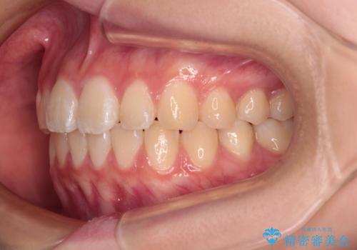 インビザラインは使える自信がない ワイヤー装置にて矯正治療の治療後