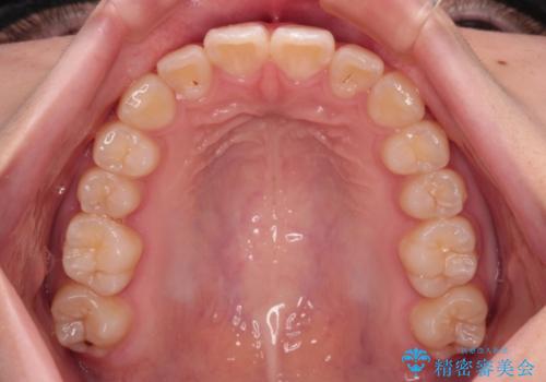 インビザラインは使える自信がない ワイヤー装置にて矯正治療の治療後