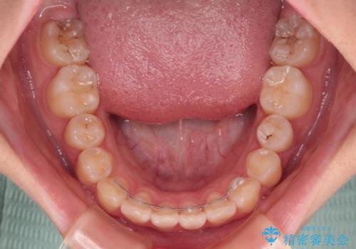 インビザラインは使える自信がない ワイヤー装置にて矯正治療の治療後