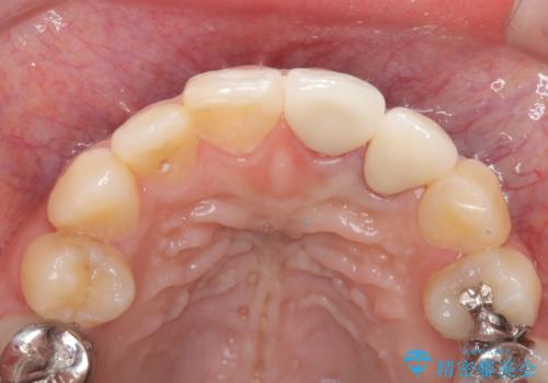 前歯の歯茎の黒ずみと被せ物の形と色が気になる【オールセラミッククラウン】の治療後