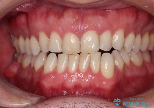 前歯でものを噛みきりたい　目立たない装置でのワイヤー矯正の症例 治療前