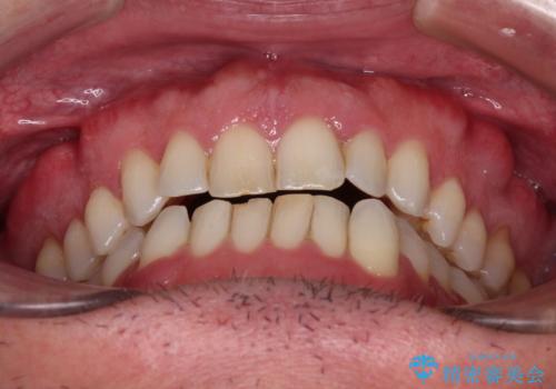 前歯でものを噛みきりたい 目立たない装置でのワイヤー矯正の治療前