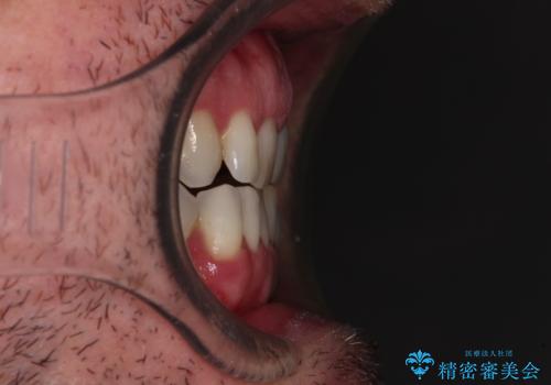 前歯でものを噛みきりたい 目立たない装置でのワイヤー矯正の治療前