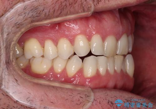 前歯でものを噛みきりたい　目立たない装置でのワイヤー矯正の治療前
