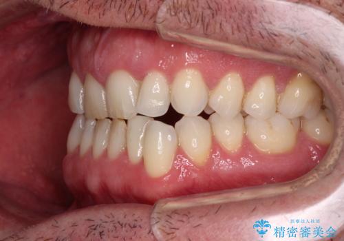 前歯でものを噛みきりたい 目立たない装置でのワイヤー矯正の治療前