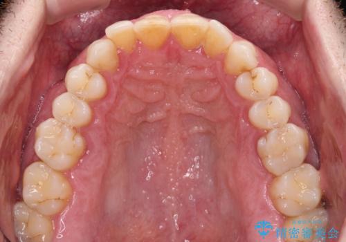 前歯でものを噛みきりたい 目立たない装置でのワイヤー矯正の治療前