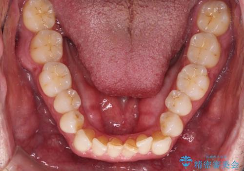 前歯でものを噛みきりたい 目立たない装置でのワイヤー矯正の治療前