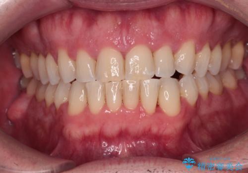前歯でものを噛みきりたい　目立たない装置でのワイヤー矯正の症例 治療後