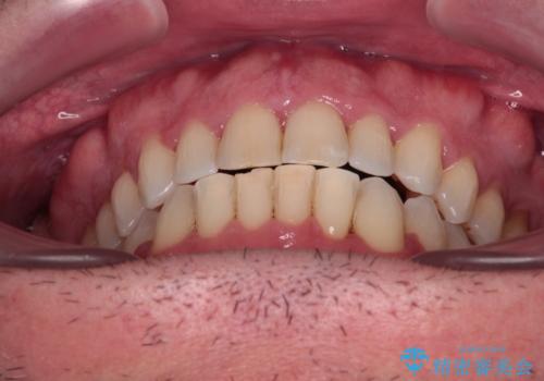 前歯でものを噛みきりたい　目立たない装置でのワイヤー矯正の治療後