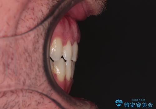 前歯でものを噛みきりたい 目立たない装置でのワイヤー矯正の治療後