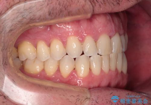 前歯でものを噛みきりたい 目立たない装置でのワイヤー矯正の治療後