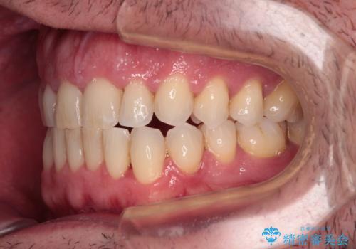 前歯でものを噛みきりたい　目立たない装置でのワイヤー矯正の治療後