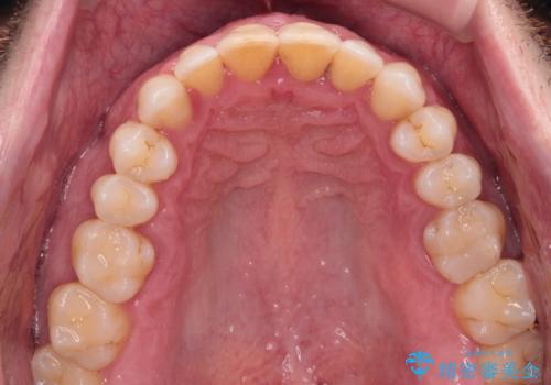 前歯でものを噛みきりたい 目立たない装置でのワイヤー矯正の治療後
