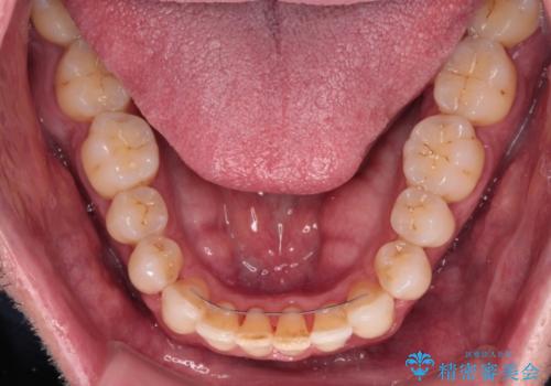 前歯でものを噛みきりたい 目立たない装置でのワイヤー矯正の治療後