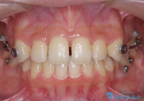 歯を抜かない矯正 出っ歯を抜かずに大きく下げることは可能です。の治療中