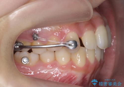 歯を抜かない矯正　出っ歯を抜かずに大きく下げることは可能です。の治療中