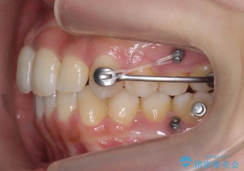 歯を抜かない矯正 出っ歯を抜かずに大きく下げることは可能です。の治療中