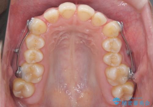 歯を抜かない矯正 出っ歯を抜かずに大きく下げることは可能です。の治療中