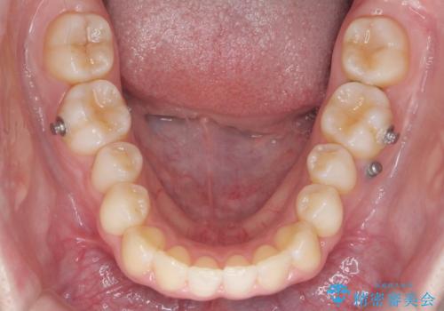 歯を抜かない矯正　出っ歯を抜かずに大きく下げることは可能です。の治療中
