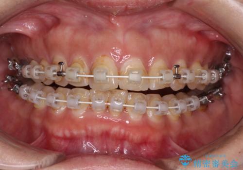 【モニター】飛び出た前歯を整えたい ワイヤー矯正治療の治療中