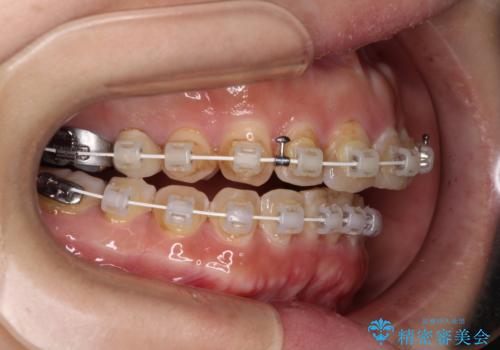 【モニター】飛び出た前歯を整えたい ワイヤー矯正治療の治療中