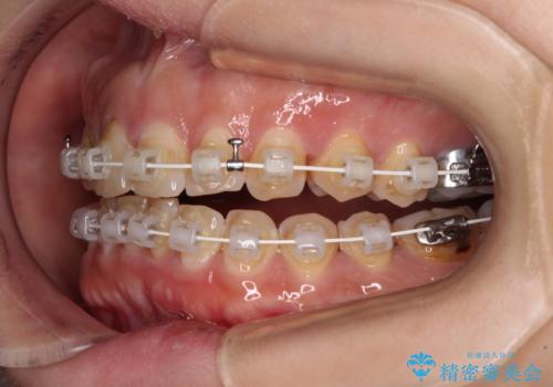 【モニター】飛び出た前歯を整えたい ワイヤー矯正治療の治療中