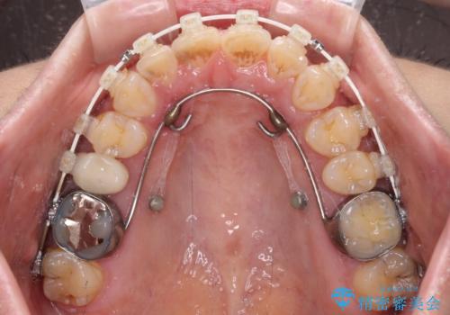 【モニター】飛び出た前歯を整えたい ワイヤー矯正治療の治療中