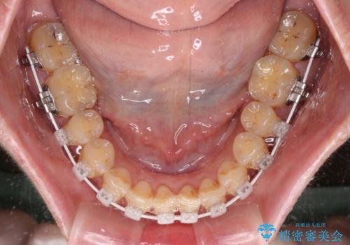 【モニター】飛び出た前歯を整えたい ワイヤー矯正治療の治療中