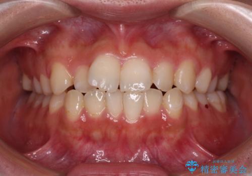 【モニター】短期間で終わりたい ワイヤー装置での非抜歯矯正の症例 治療前