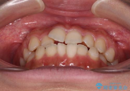 【モニター】短期間で終わりたい ワイヤー装置での非抜歯矯正の治療前